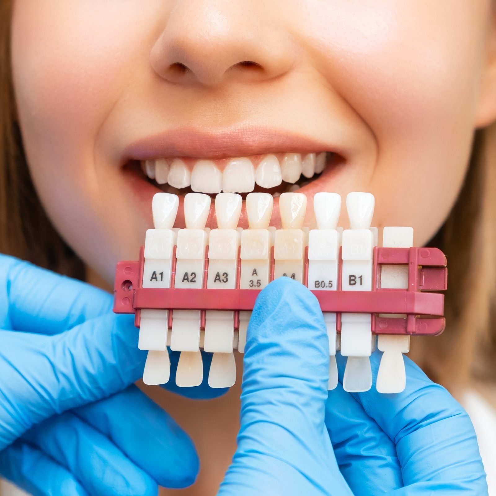 Un teintier tenu près des dents pour comparer la couleur avant un blanchiment.