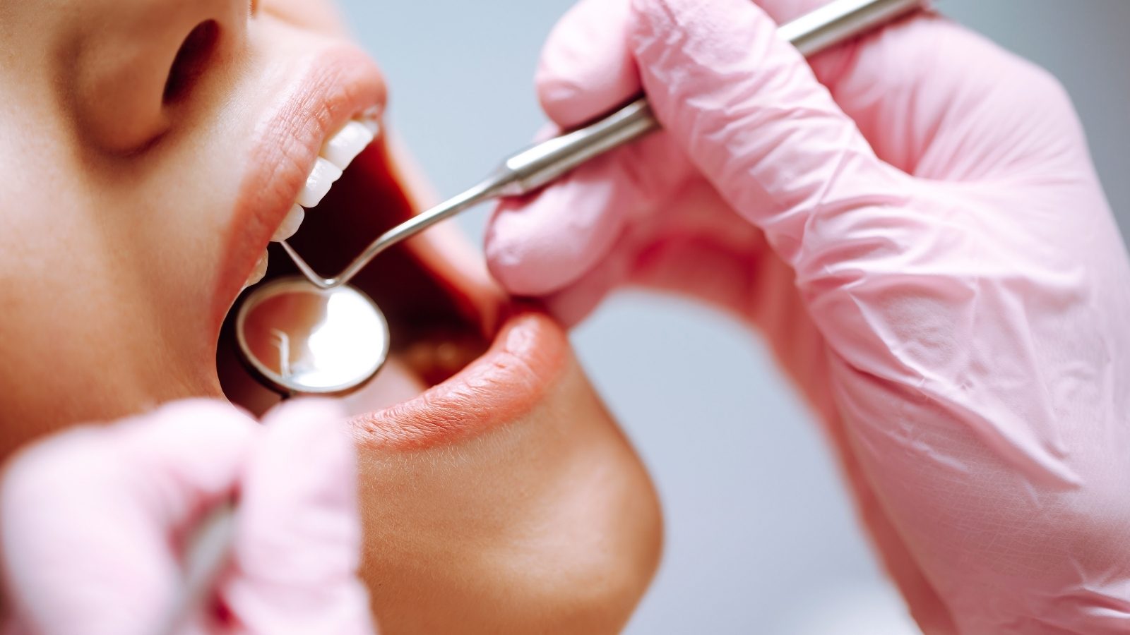 Un examen en cours : le miroir et la sonde du dentiste parcourent les dents du haut.