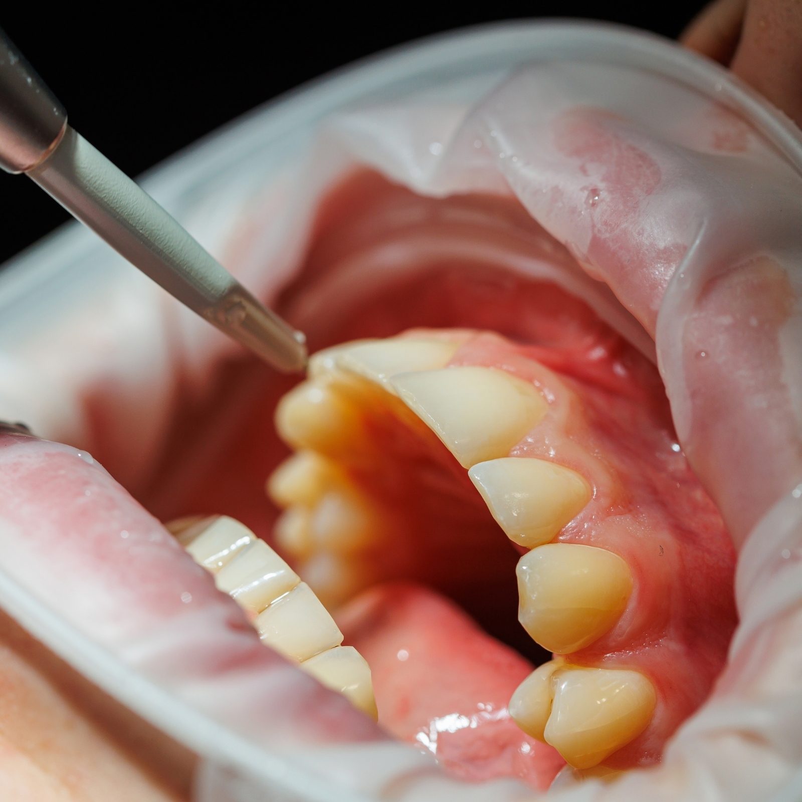 Deux instruments approchent la gencive, sous les dents du bas.