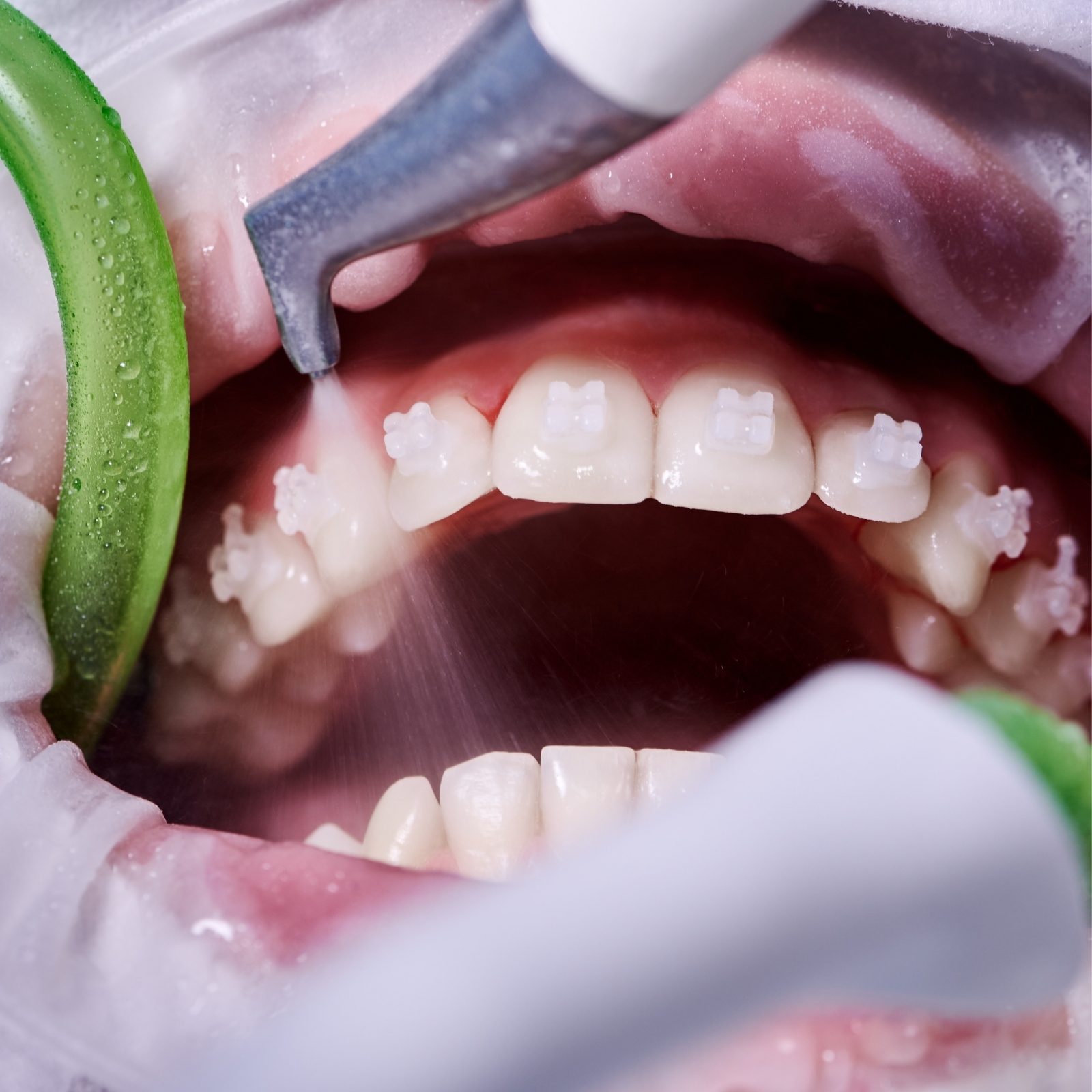 Un écarteur dégage les lèvres et laisse voir les dents du haut et du bas.