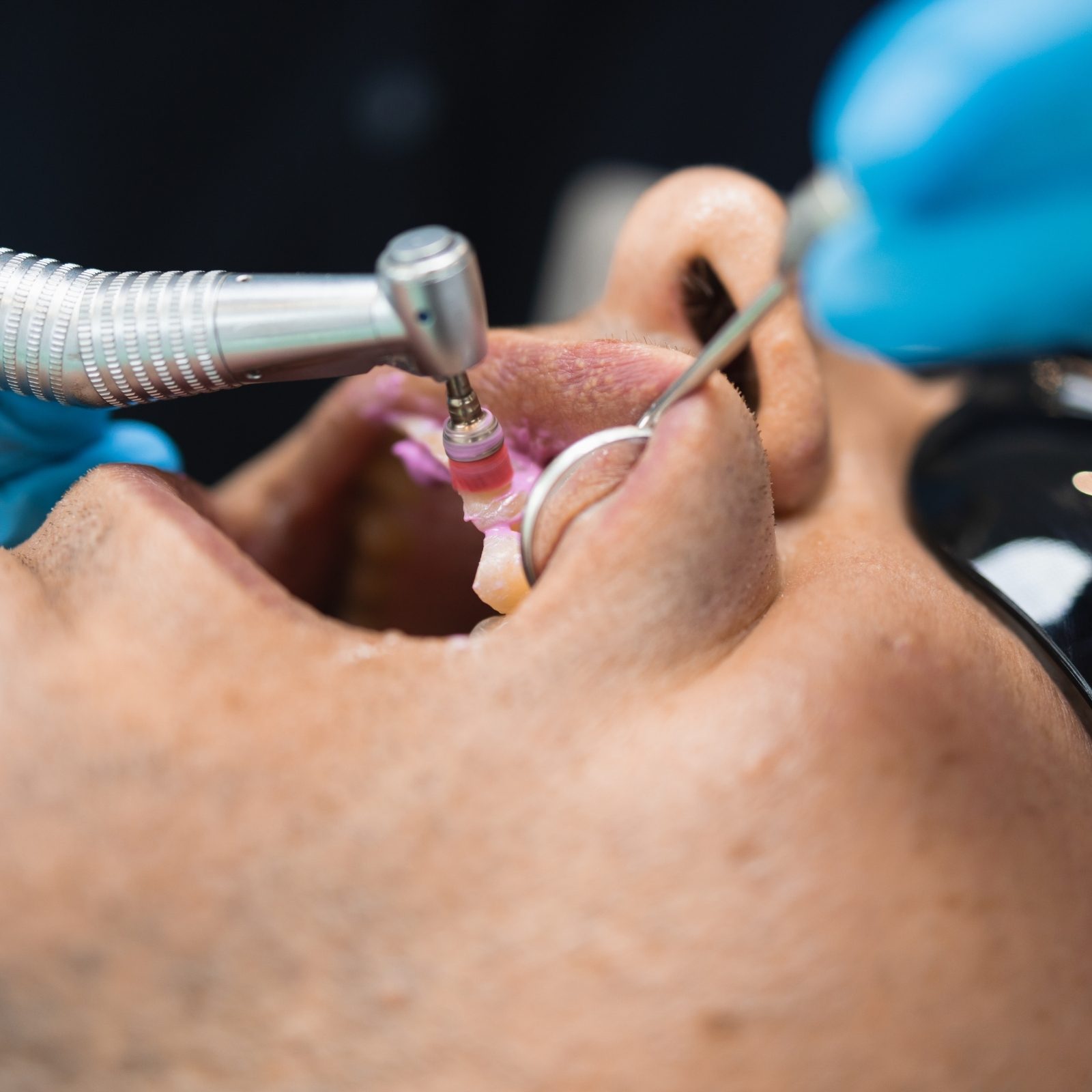 Vue de profil : un instrument rotatif et un miroir travaillent sur les dents d’un patient.